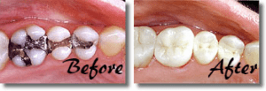 Before and After Amalgam Filling Removal